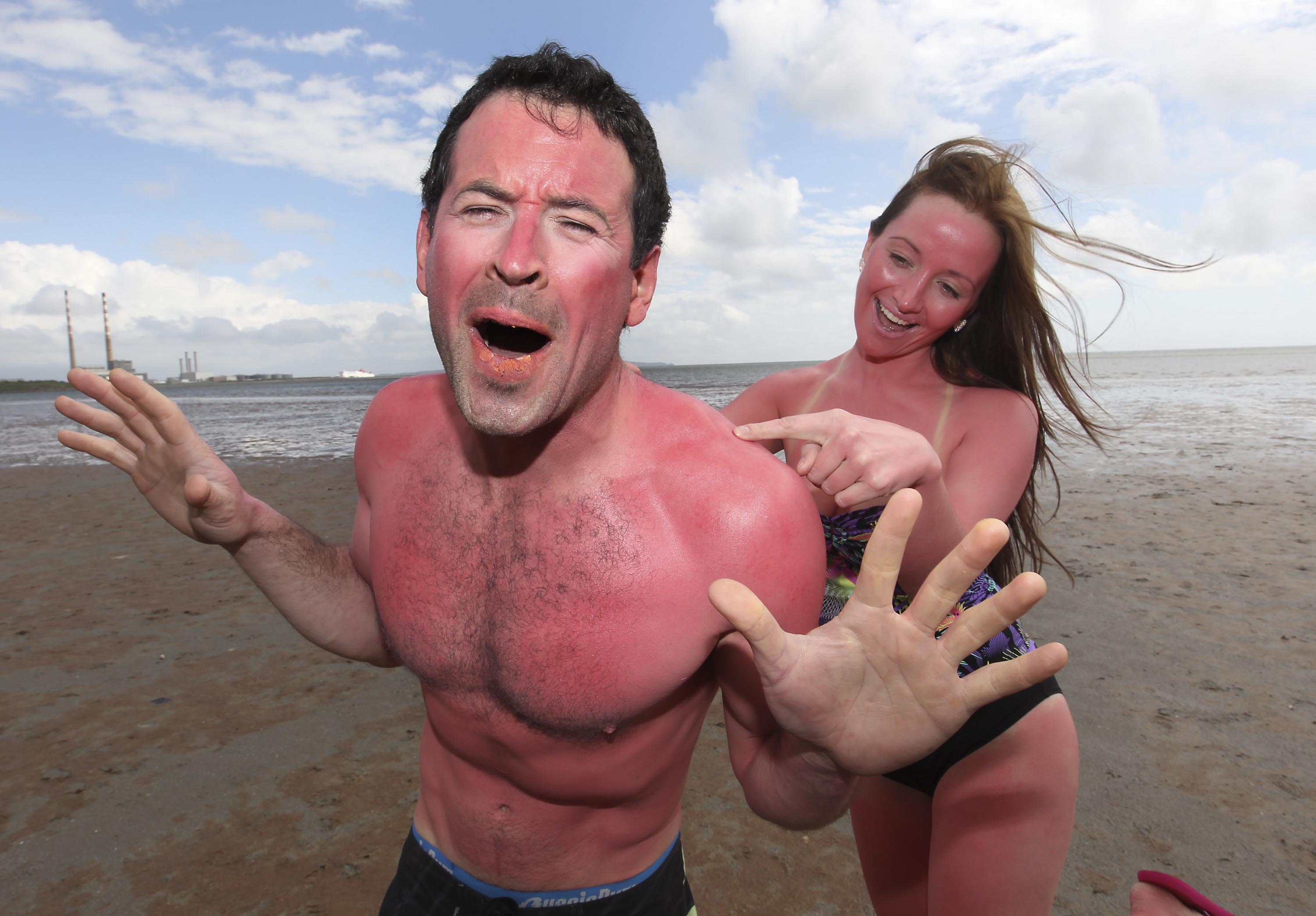 You don’t have to get sunburned to get skin cancer, but it helps