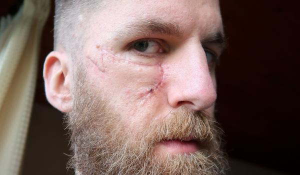 James Anthony's Skin Cancer Story