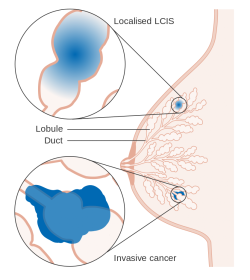 Diagram of LCIS - lobular carcinoma in situ