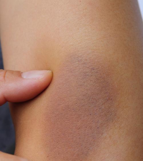 Bruise on an arm