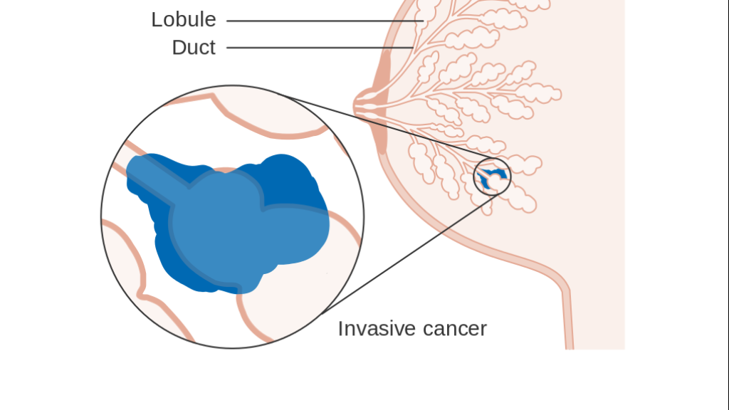 Diagram of LCIS - lobular carcinoma in situ