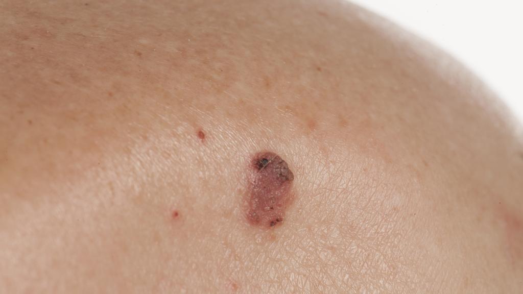 Image of keratinising squamous cell carcinoma skin cancer