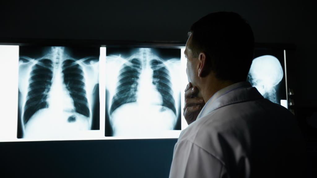 Doctor looking at lung x-ray