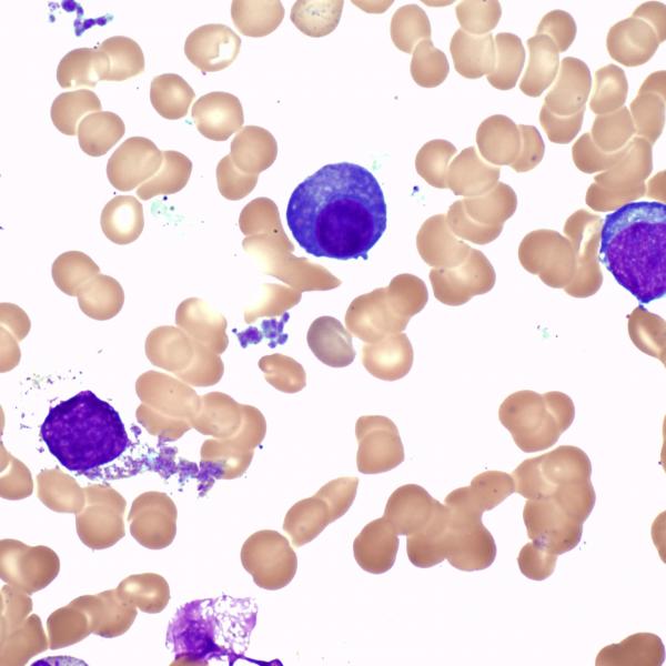 Blood cells cancer
