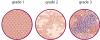 Cancer grading diagram