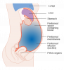 Ascites (Fluid build-up in the tummy)