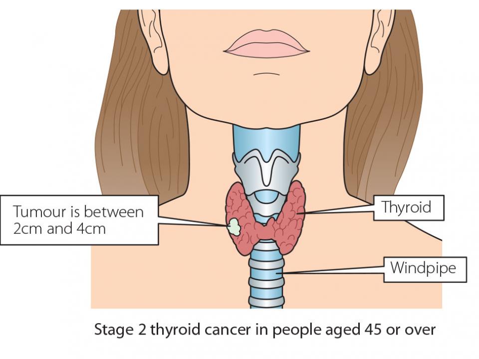 research topics thyroid cancer