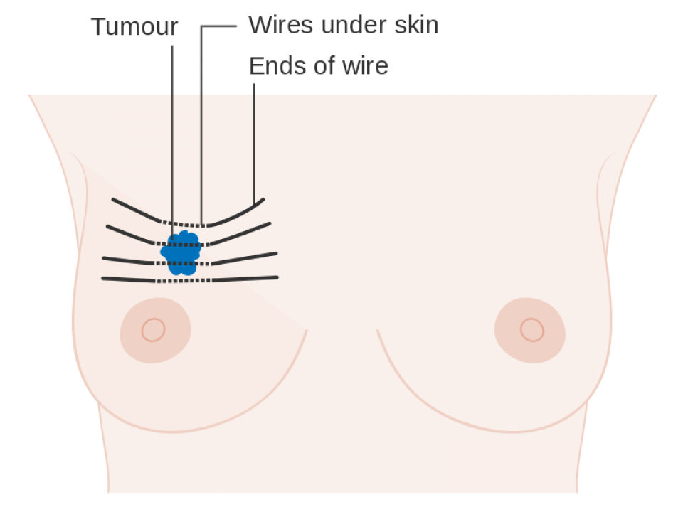 Diagram of brachytherapy or interstitial radiotherapy