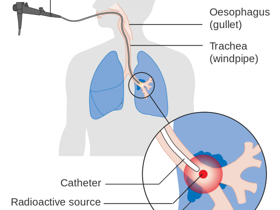 symptom of lung cancer