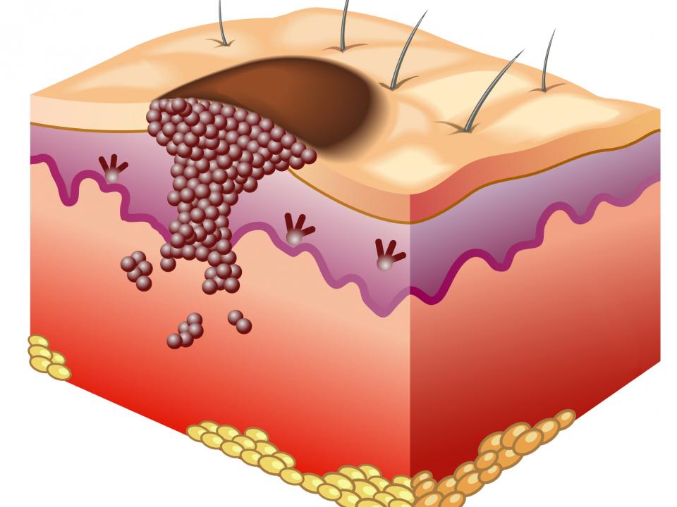 Skin with melanoma diagram