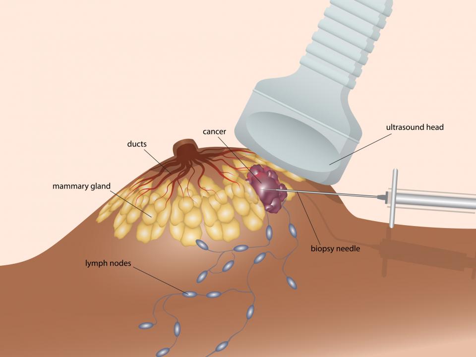 Diagram of ultrasound and biopsy