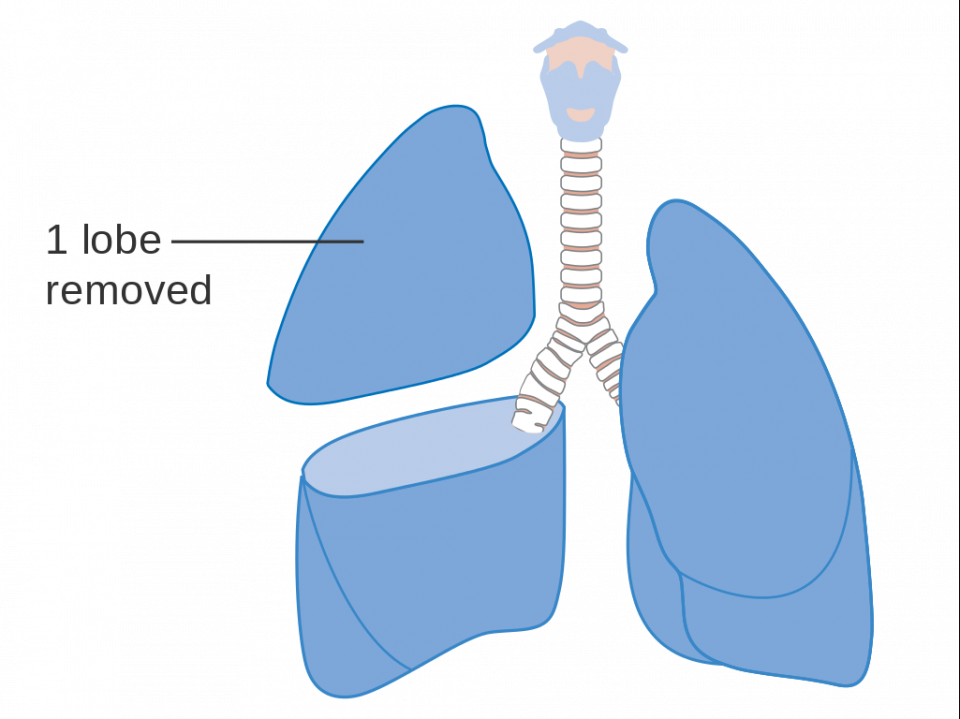 Lobectomy For Lung Cancer | Lung Resection Surgery: Procedure, Details ...