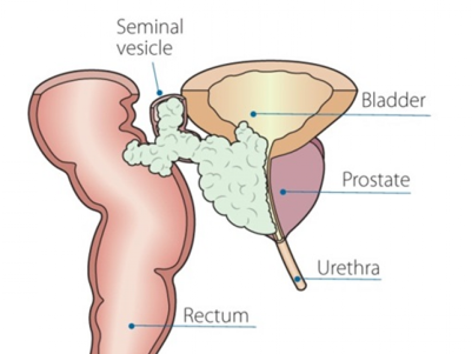 secondary prostate cancer)