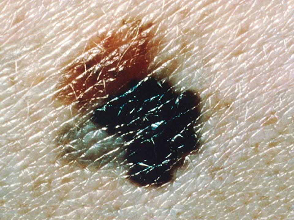 Symptoms And Diagnosis Of Melanoma Irish Cancer Society