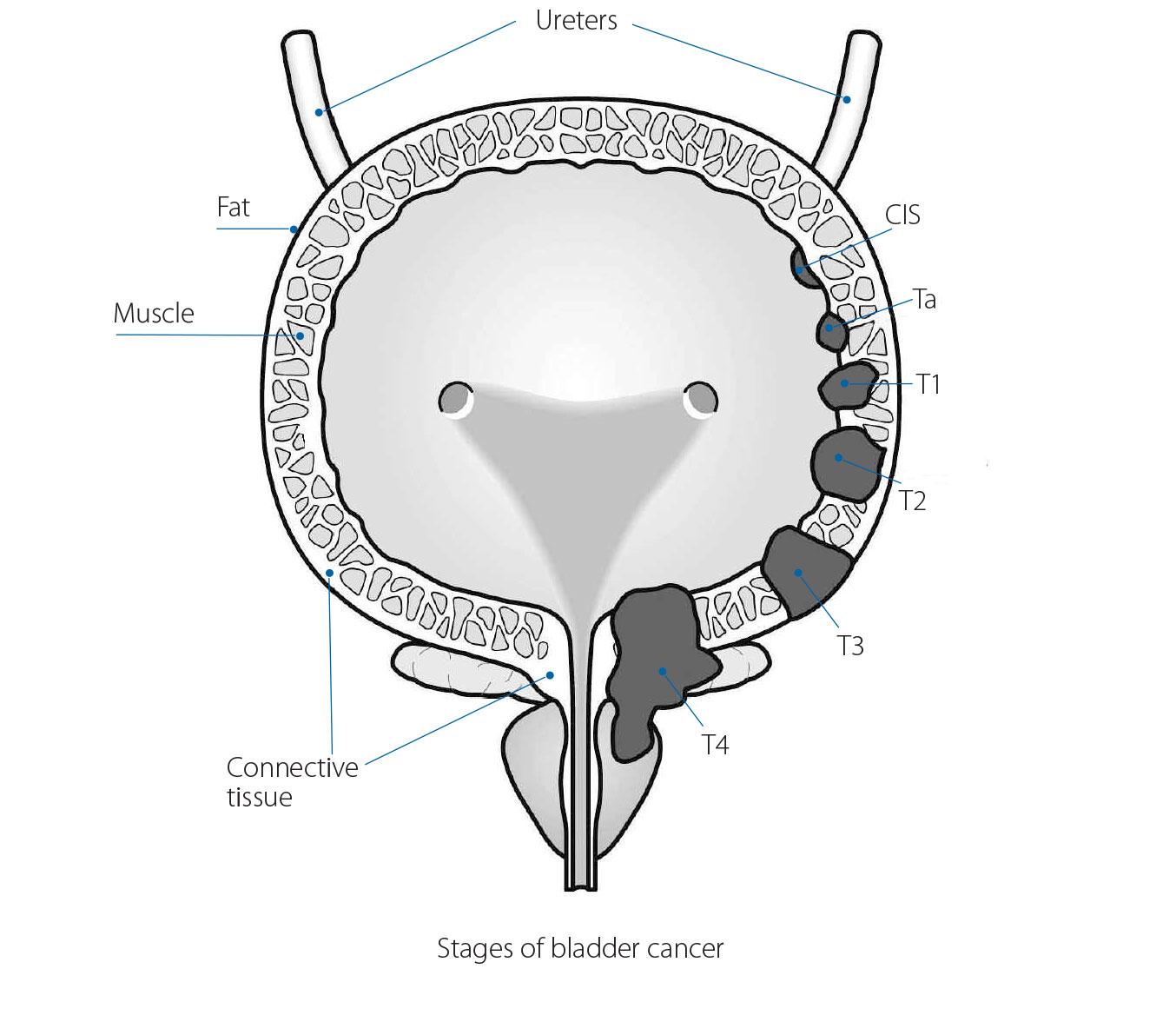 Stages of bladdr cancer