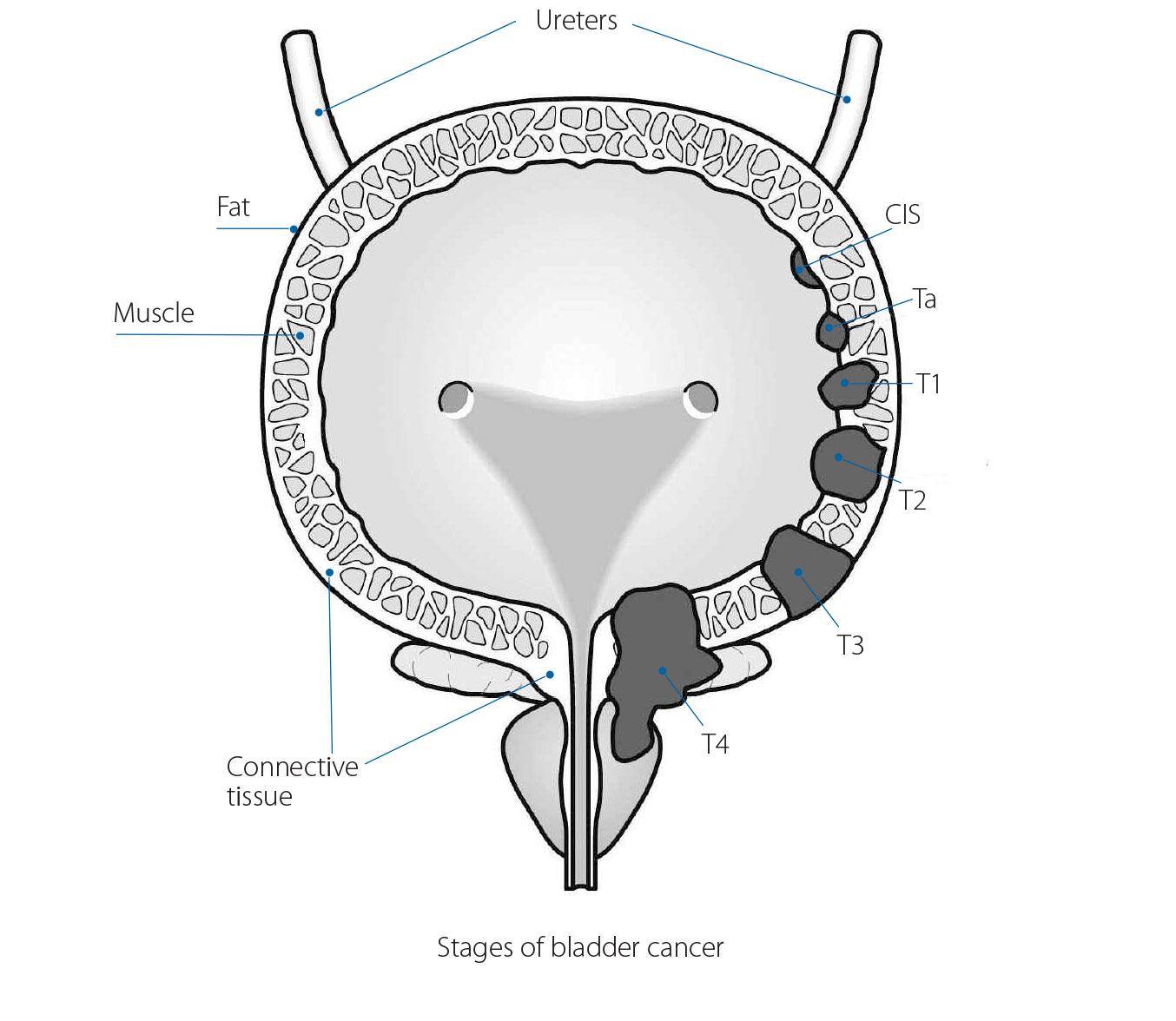 What are the grades and stages of bladder cancer? | Irish ...