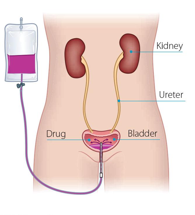 Liquid chemotherapy treatment for bladder cancer