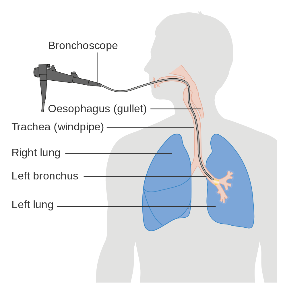 Diagram_showing_a_bronchoscopy_CRUK