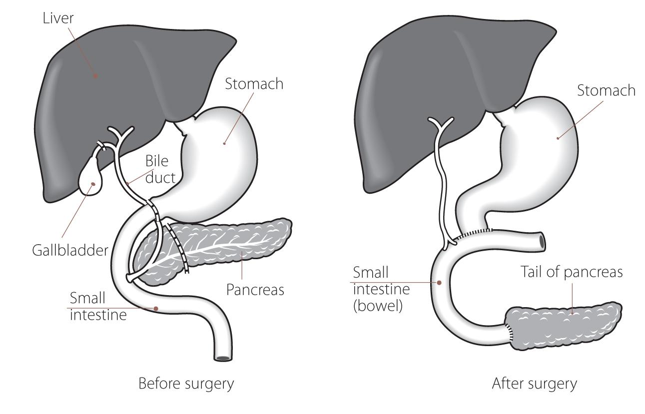 pppd pancreas