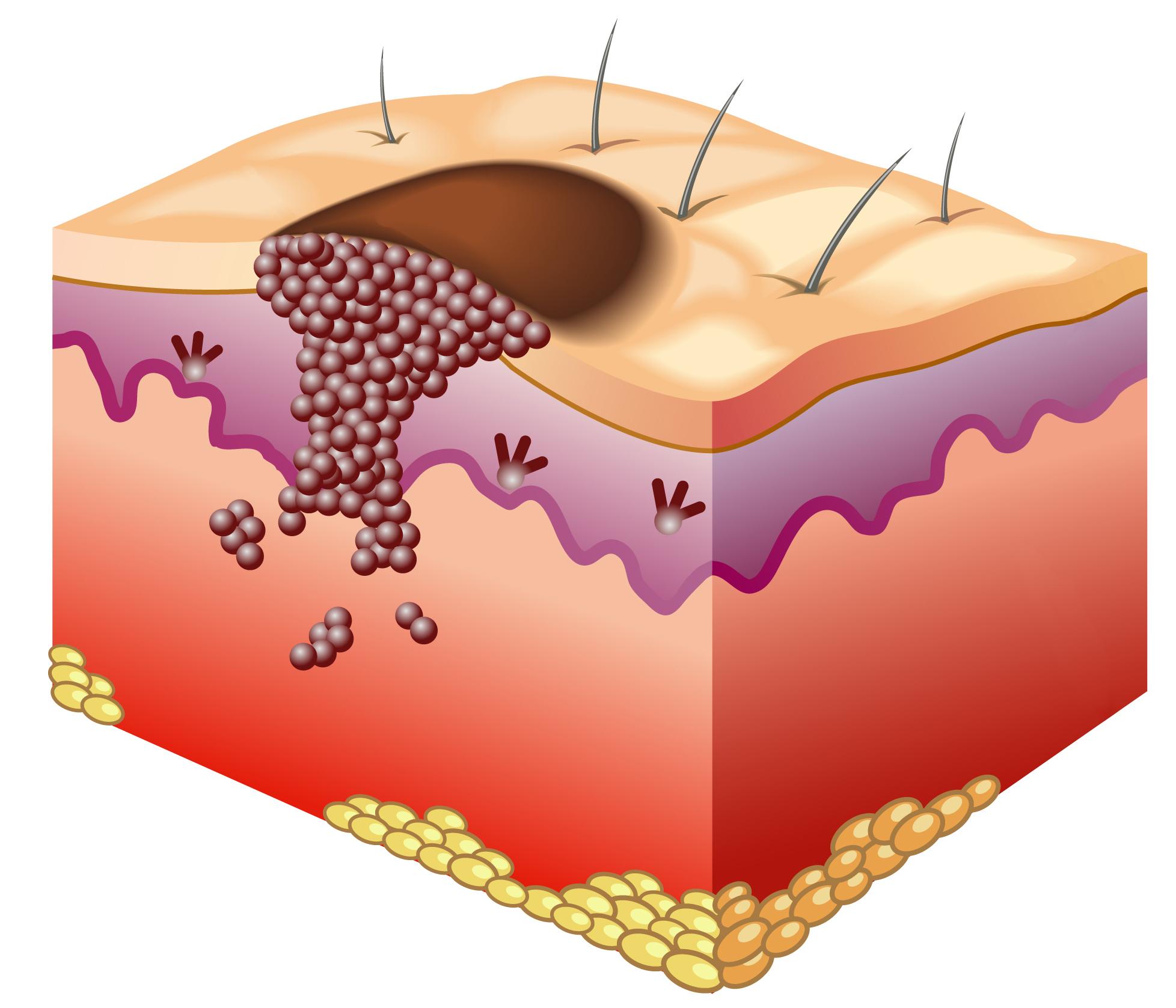 Skin with melanoma diagram