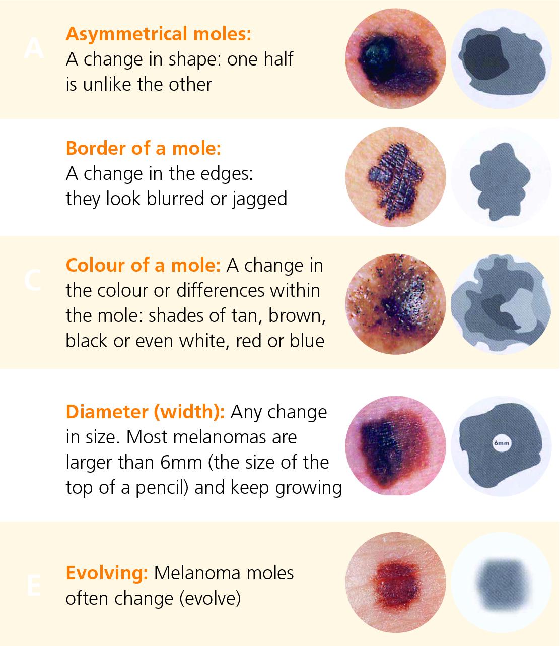 Abcde Melanoma Maligna Malignant Melanoma Stages High - vrogue.co