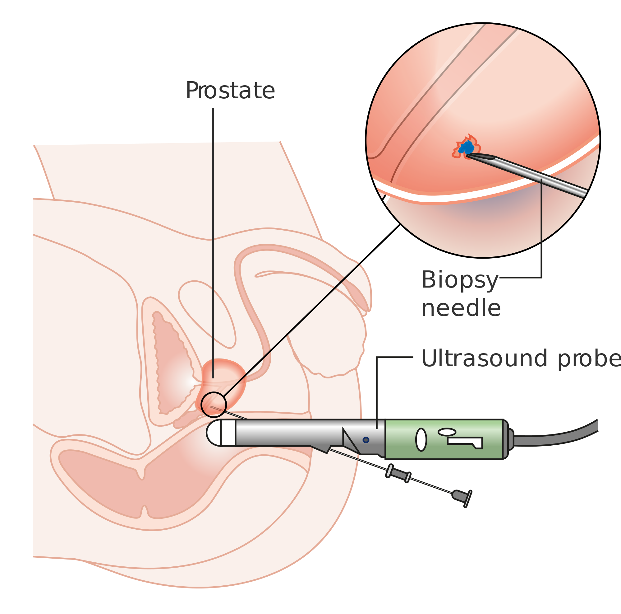Prostate biopsy on Pain Management