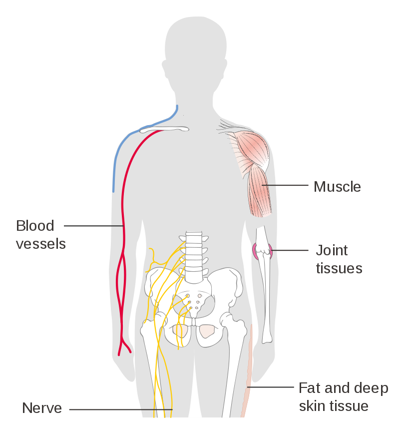 mesothelioma development