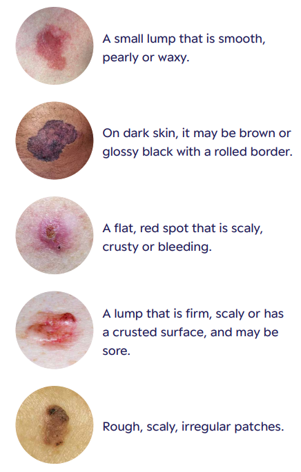 WYSK non-melanoma signs and symptoms