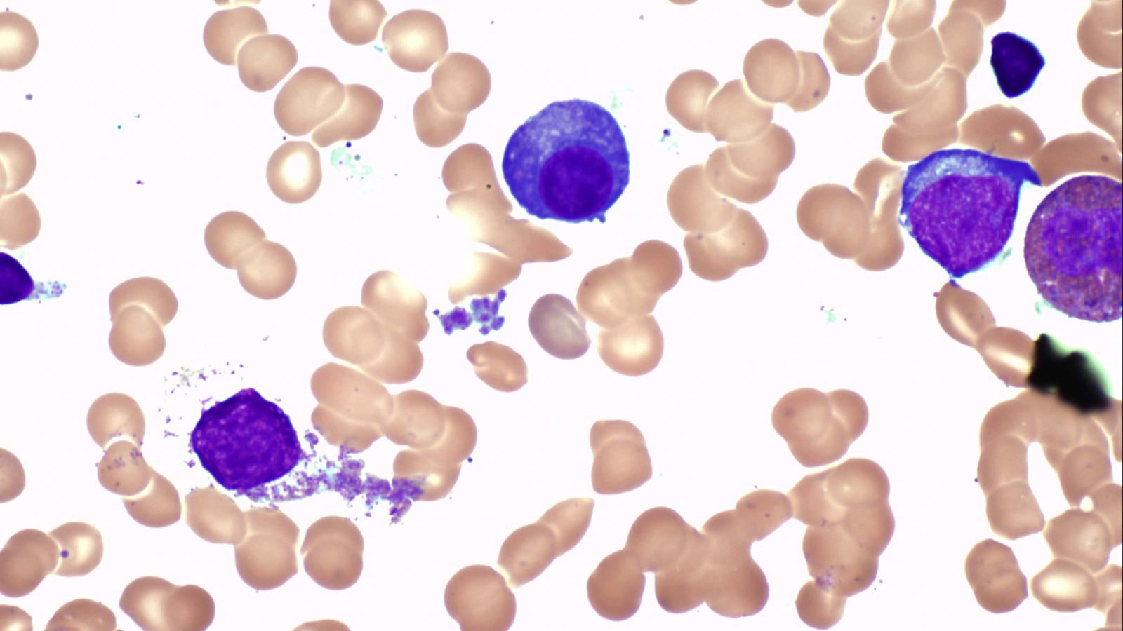 Blood cells cancer