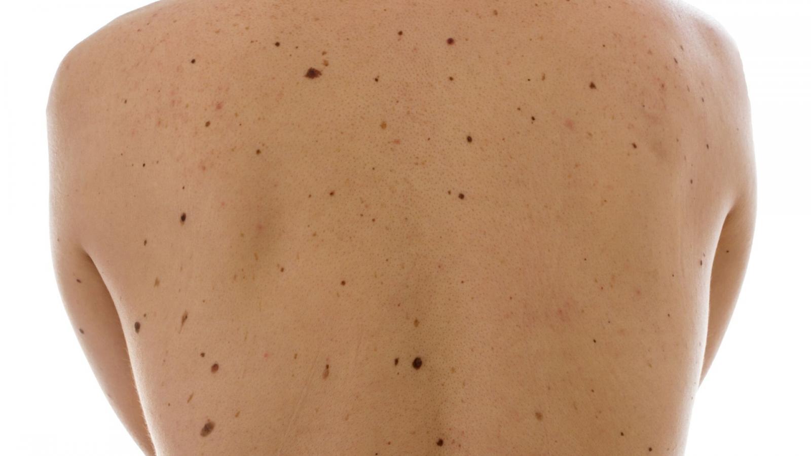 A person with a large number of moles
