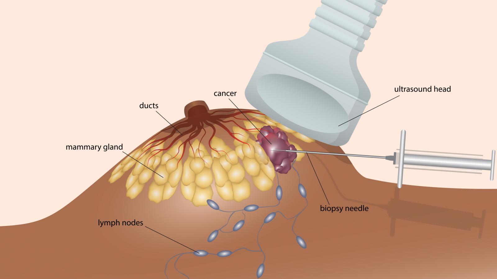 Diagram of ultrasound and biopsy