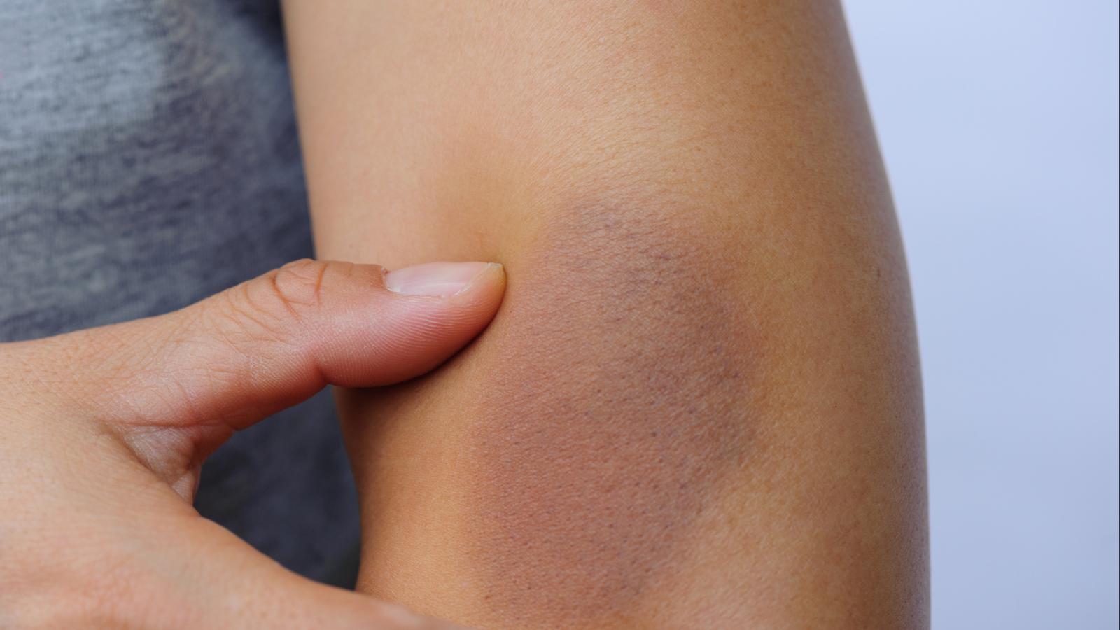 Bruise on an arm