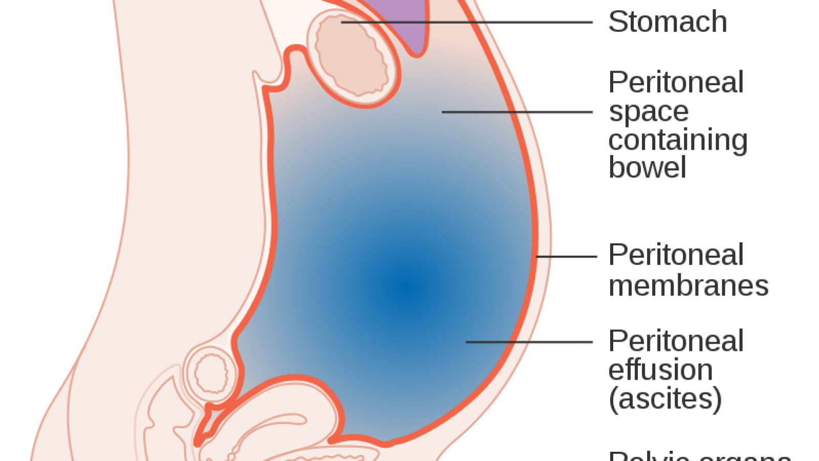 Ascites (Fluid build-up in the tummy)