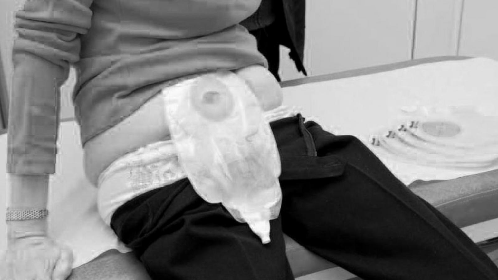 Picture of a patient with a urostomy