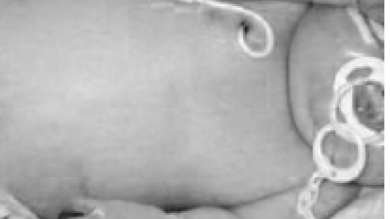 A baby with a central line tube coming from its chest